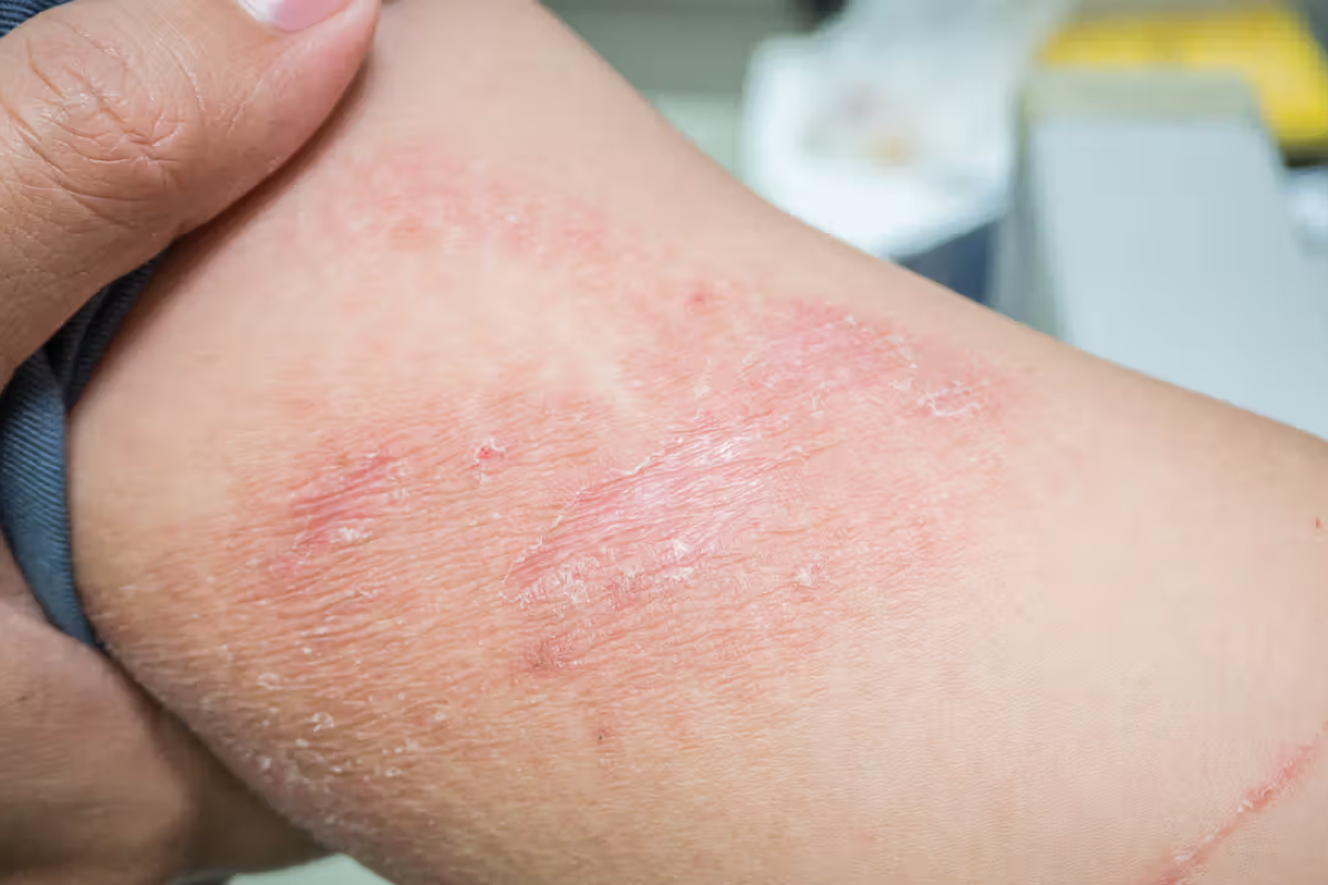 Dermatitis Treatment