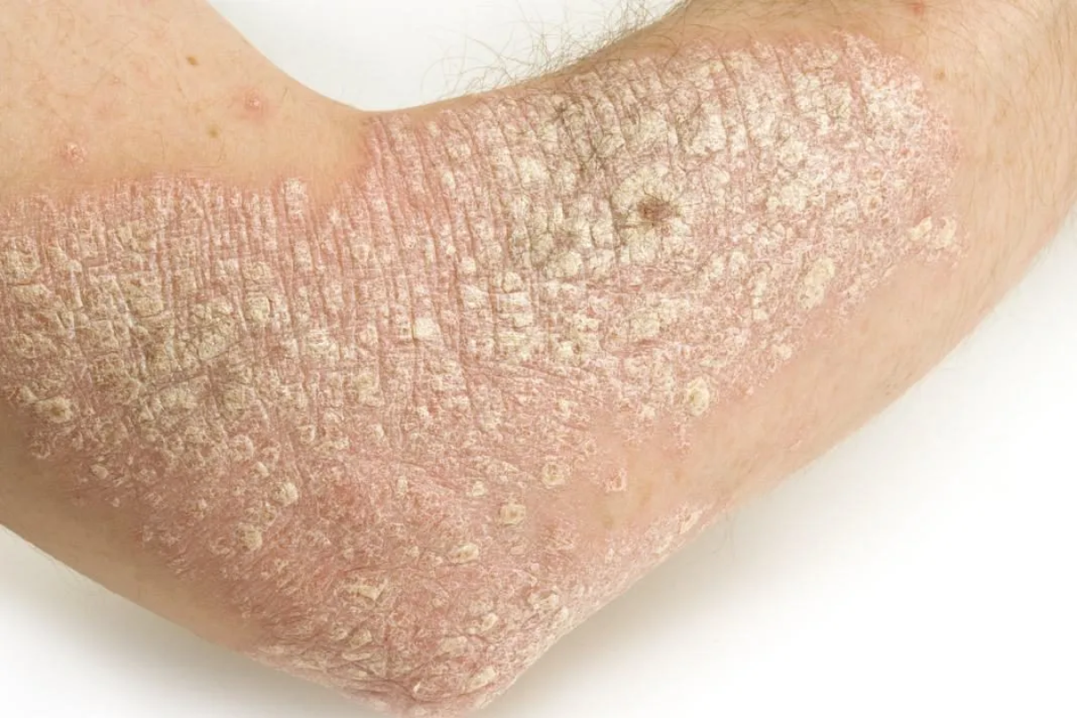 Eczema and Psoriasis Management