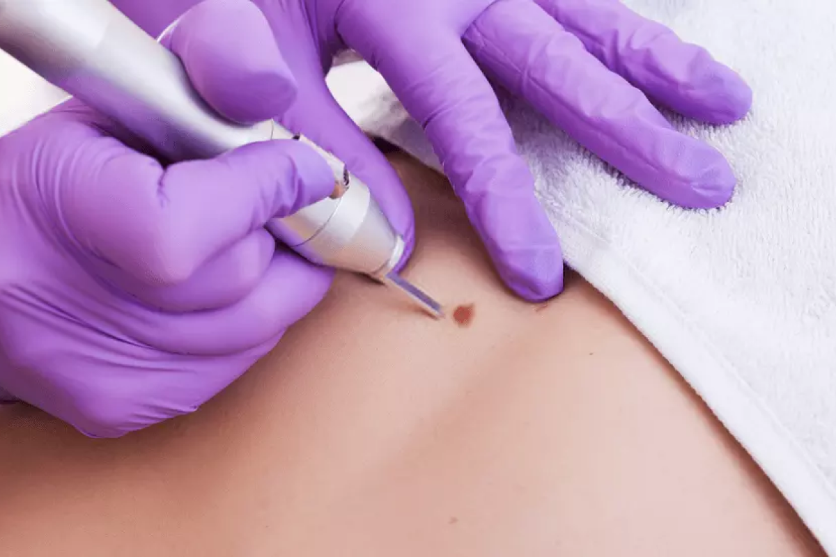 Mole and Wart Removal